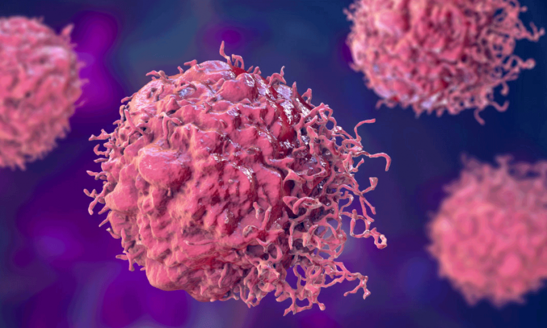 Aumento del cancer de colon en menores de 50 un reto urgente para la gestion sanitaria global