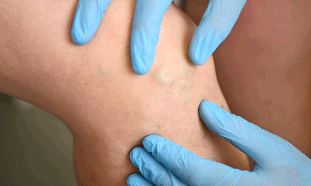 La flebologia vascular se globaliza Alianza internacional impulsa formacion medica continua