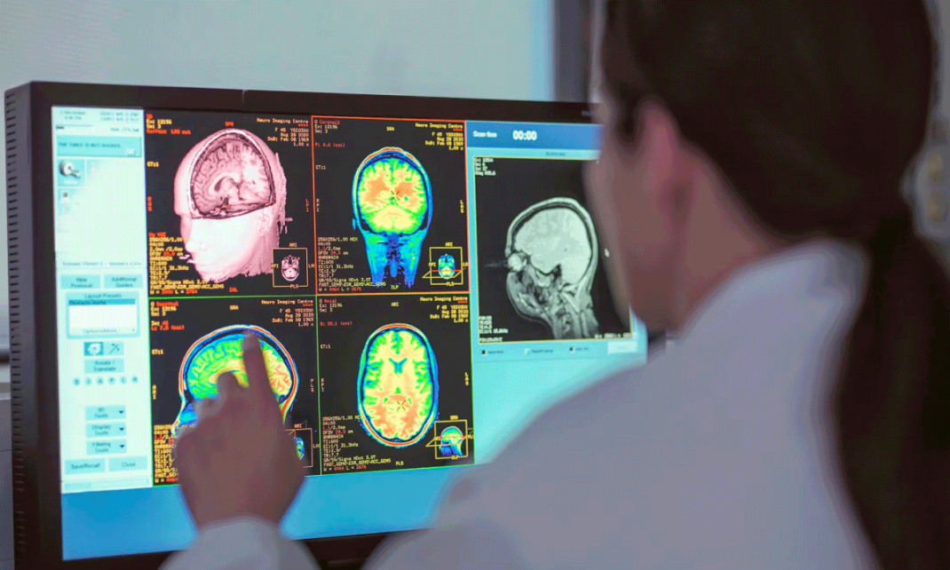 El mercado de Alzheimer desata oportunidades de inversion terapias emergentes diagnosticos y crecimiento proyectado