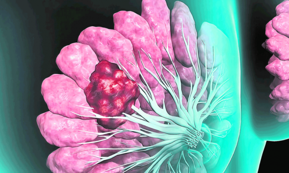 Estrategias de Dinamarca para el cancer un modelo de gestion hospitalaria eficiente y centrado en el paciente